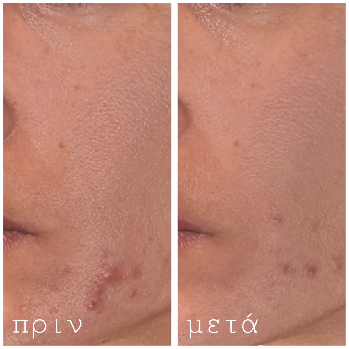 Hydrating and Post-Roller Serum