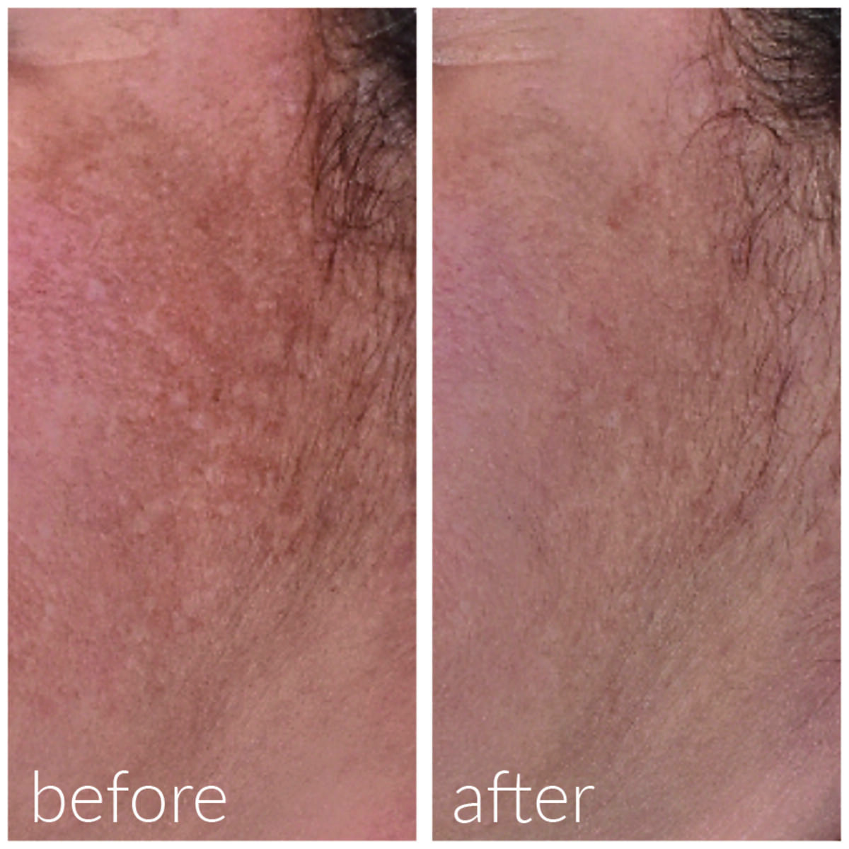 Hydrating and Post-Roller Serum